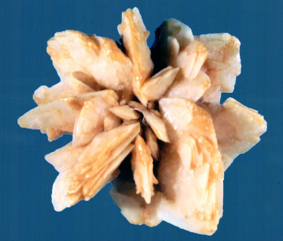 Technologists at our reference laboratory possess decades of experience in examining kidney stones. We have specialized in stone analysis for over 45 years.
