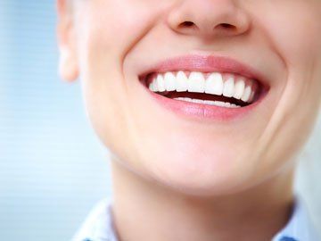 Full Mouth Reconstruction — Beautiful Teeth of a Smiling Woman in Sarasota, FL Full Mouth Reconstruction — Beautiful Teeth of a Smiling Woman in Sarasota, FL