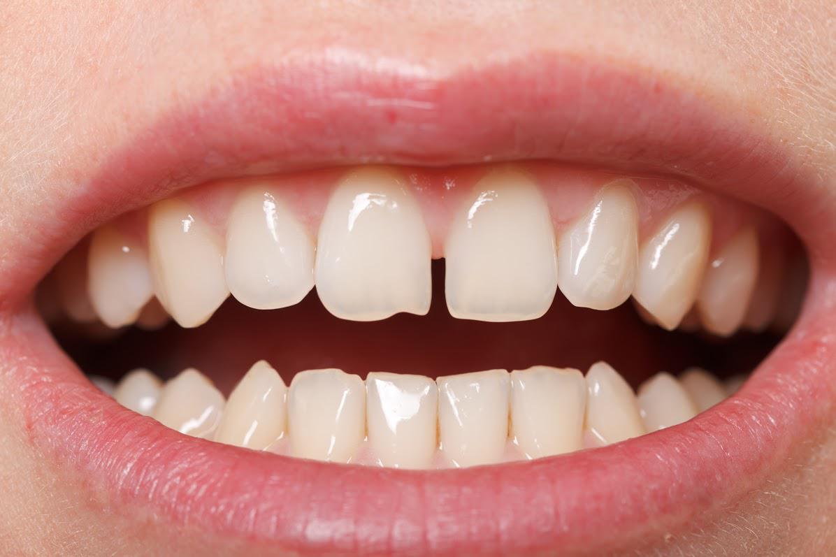 Treatments for Gaps Between Teeth Sarasota FL