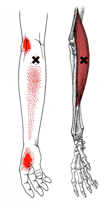 Diagram van de armanatomie met weergave van triggerpoints en pijnuitstralingspatronen.