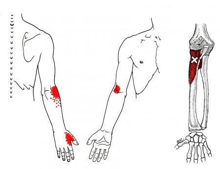 arm klachten arm pijn