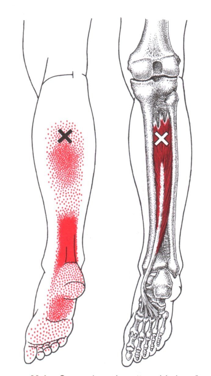 Diagram van een been, waarop de locatie van de pijn (rood gebied) en de aangedane spier (tibialis posterior) zijn aangegeven.