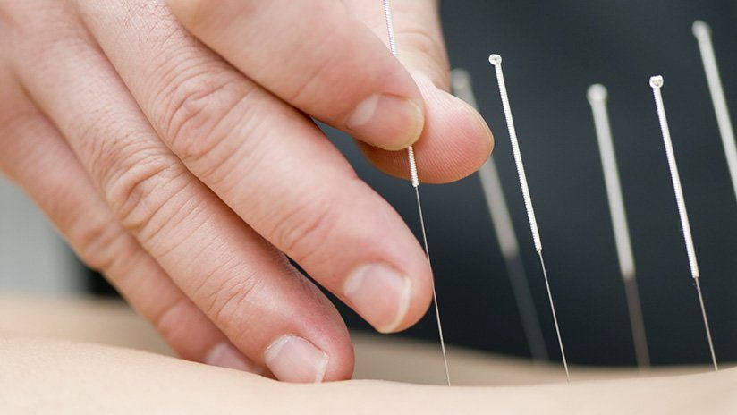 Een hand die acupunctuurnaalden in de rug van een persoon plaatst.
