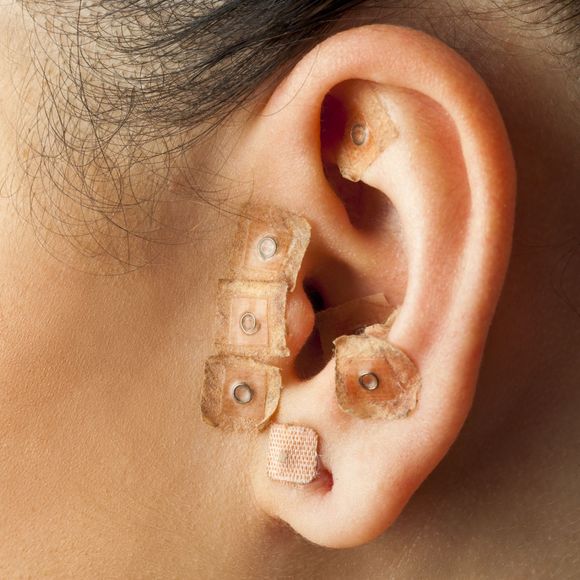 trattamento snellente di agopuntura auricolare