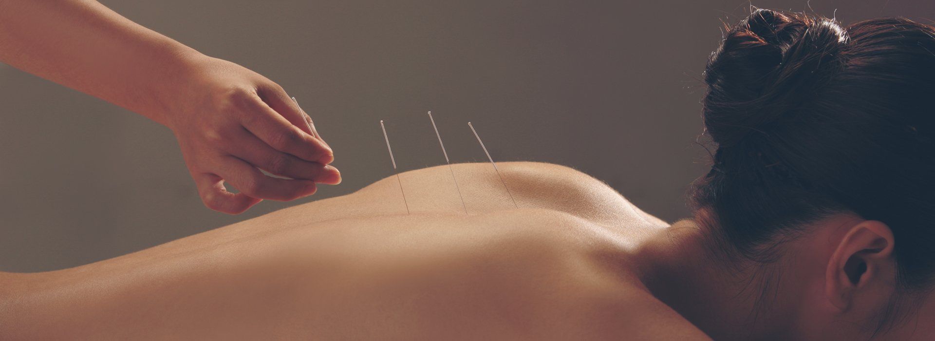 Acupuncture