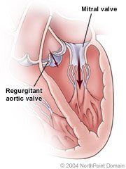 As the mitral valve opens to fill the left ventricle with blood, an regurgitant aortic valve allows blood to leak backward into the ventricle.