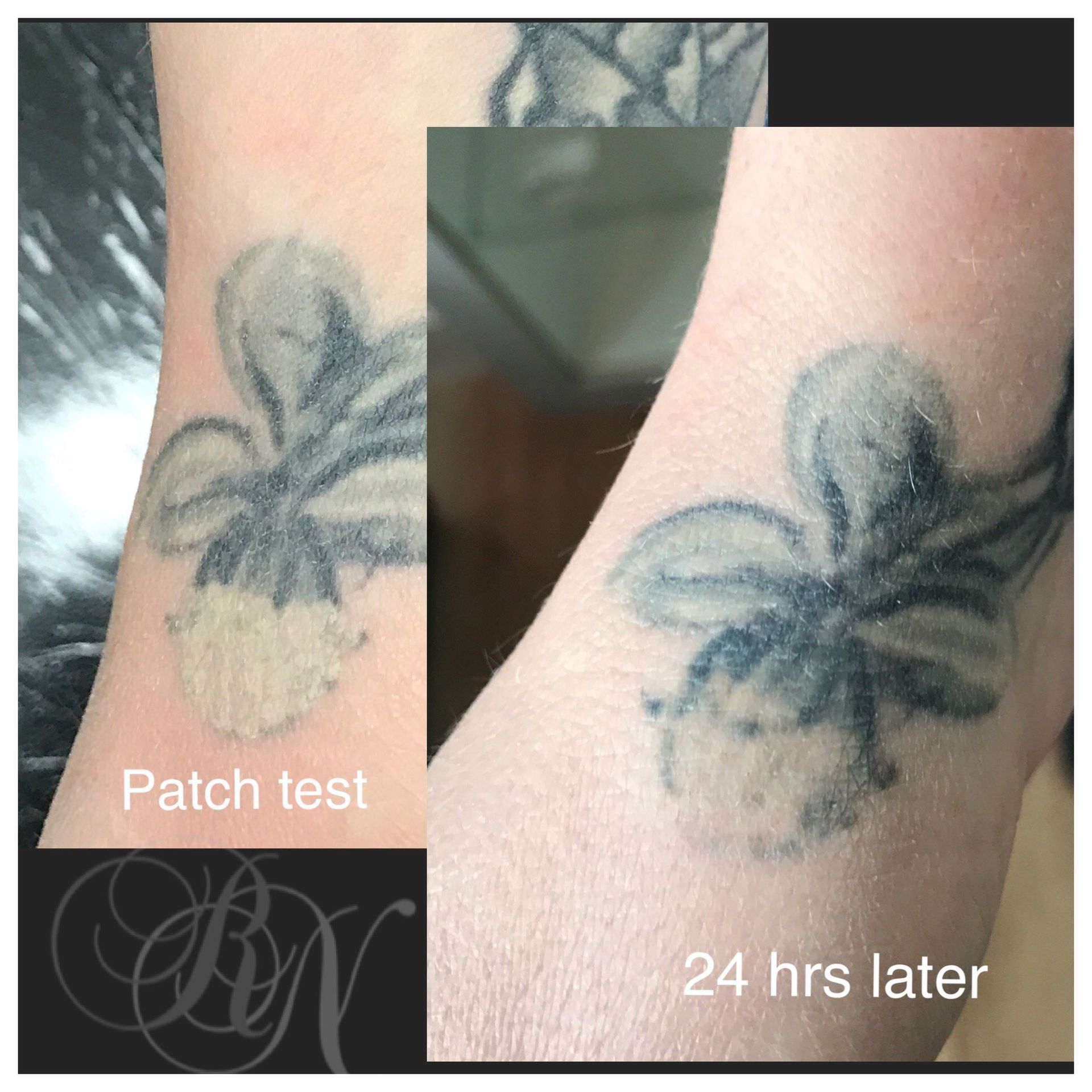 tattoo removal