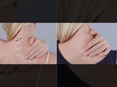 before and after a tattoo removal