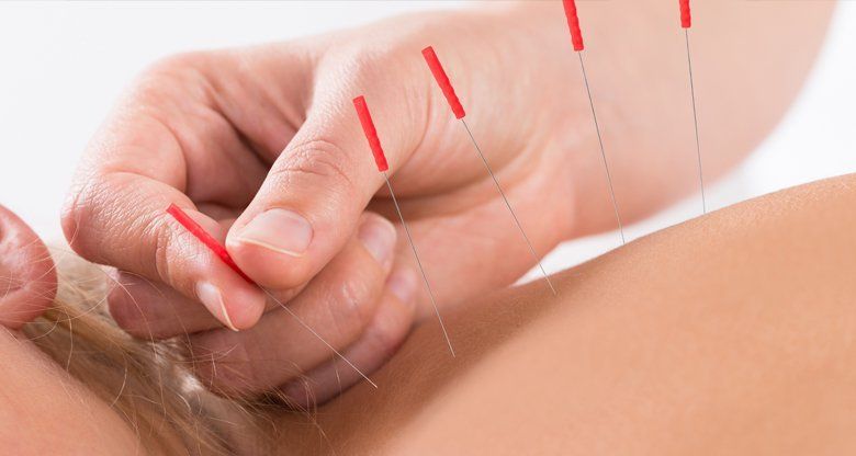 Acupuncture for back pain