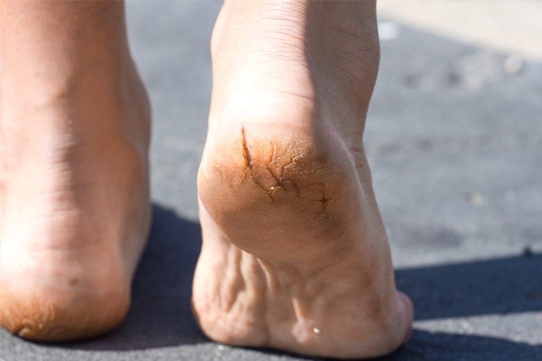Cracked heel management