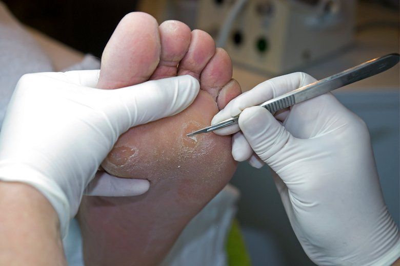 Hard skin removal
