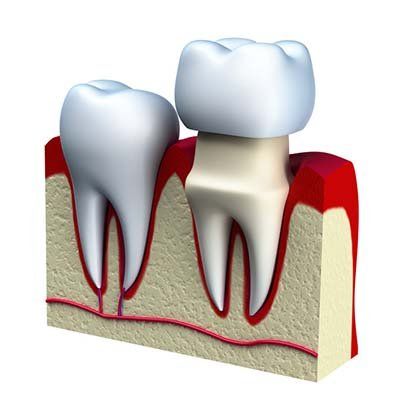 Image of dental crowns