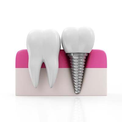 Image of dental implants
