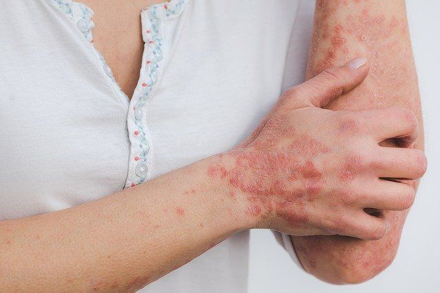 ARTRITE PSORIASICA