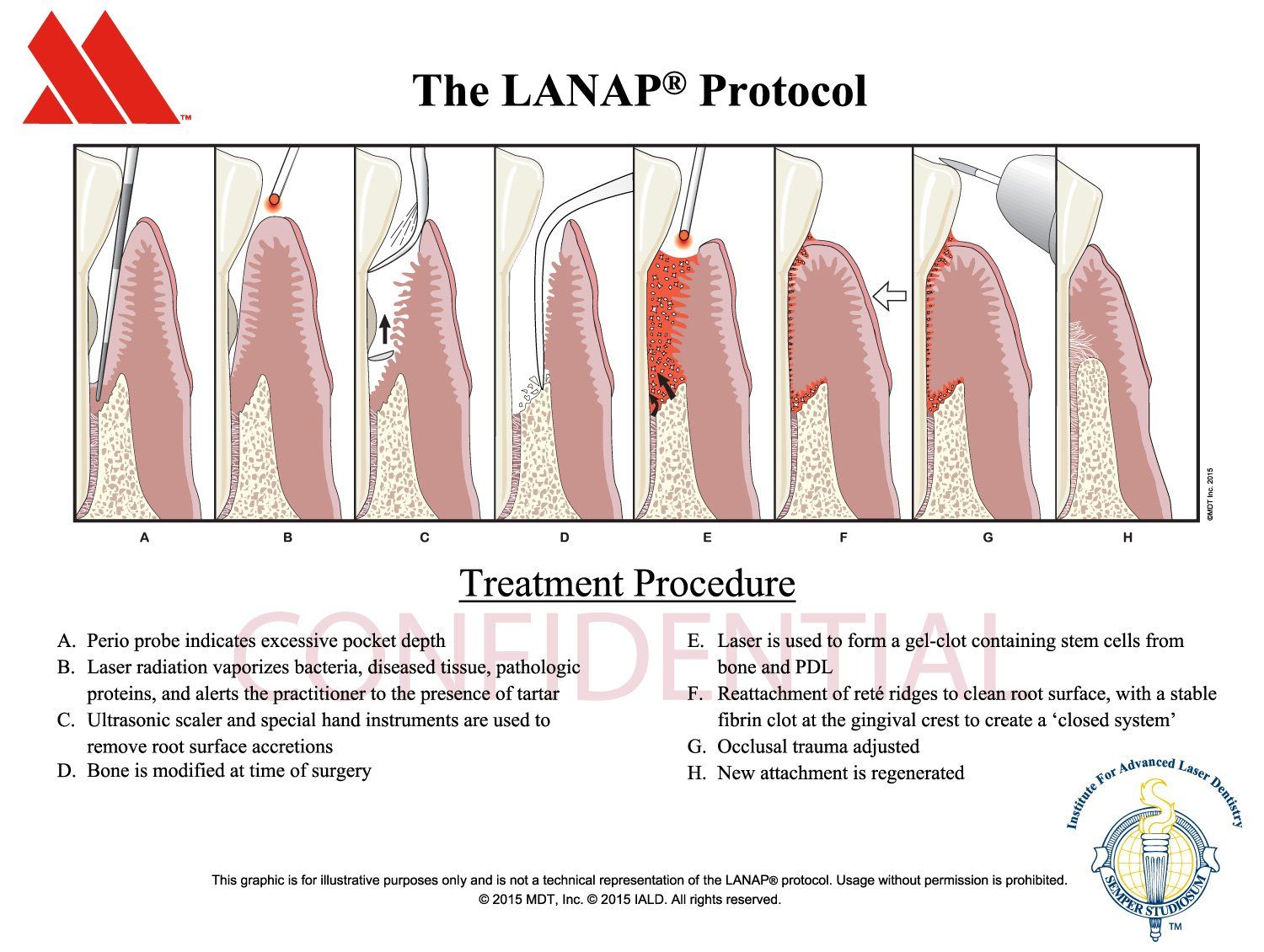 LANAP Protocol - How does it work?