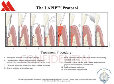 LAPIP treatment for peri-implantiits on dental implants