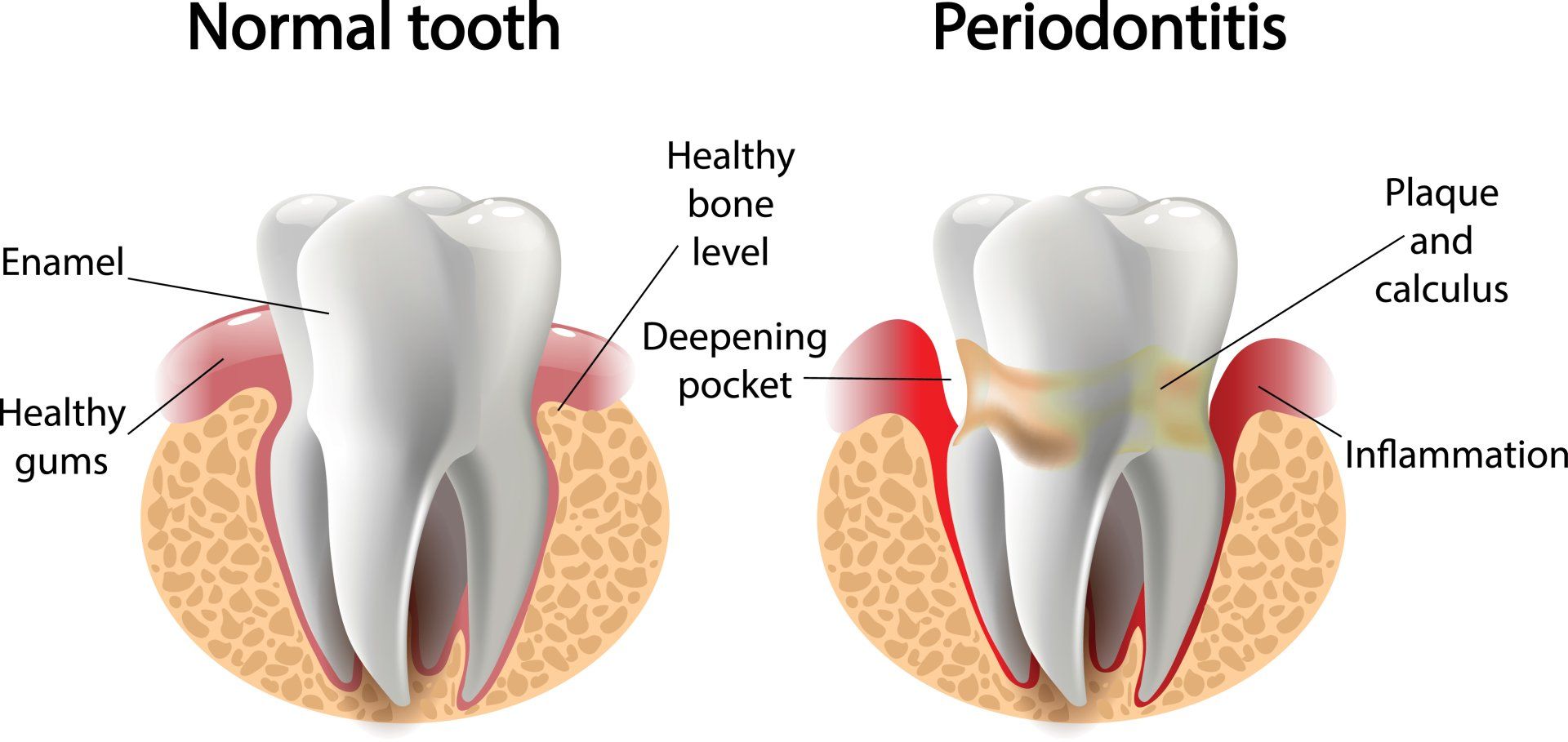 Gum disease symptoms - Periodontitis