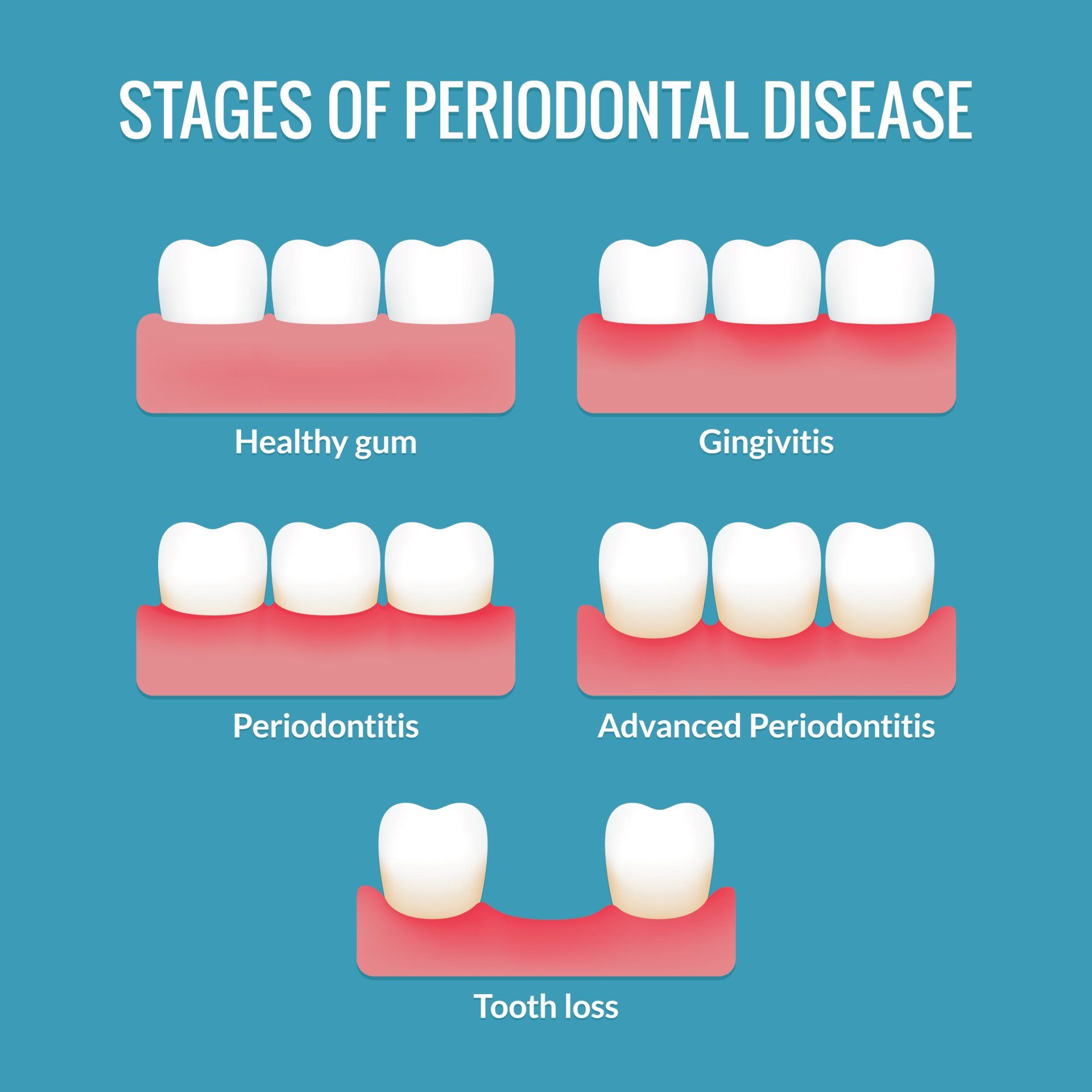 Gum Disease Treatment - Stages of Periodontitis