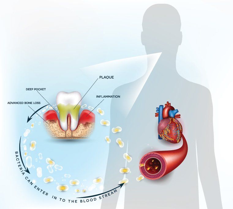 Gum disease health effects on the whole body