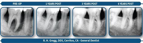 Regeneration of bone and gum treatment is a benefit of LANAP