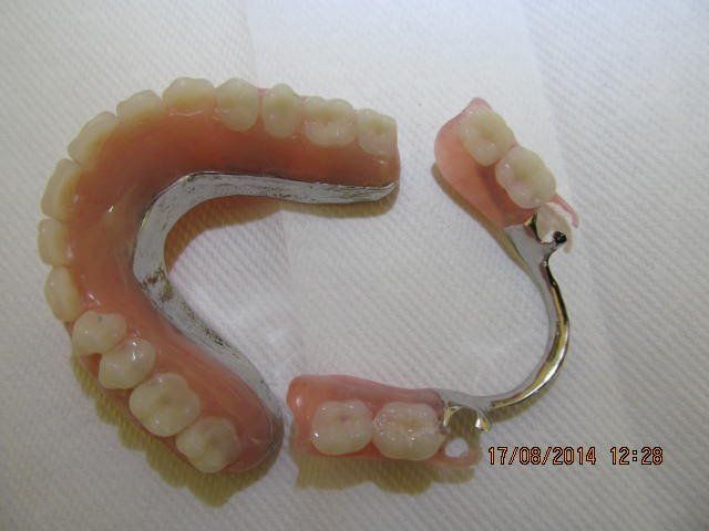 flexible chrome dentures