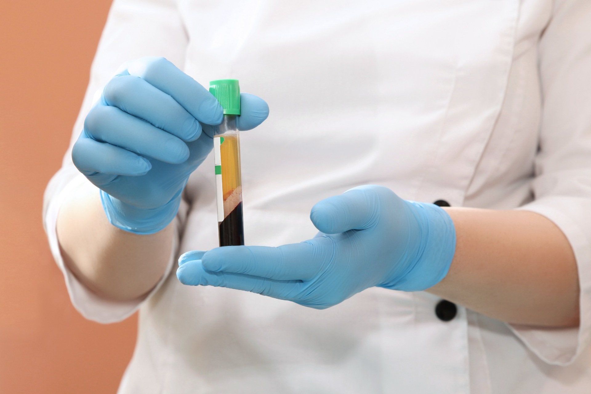 Platelet Rich Plasma (PRP)