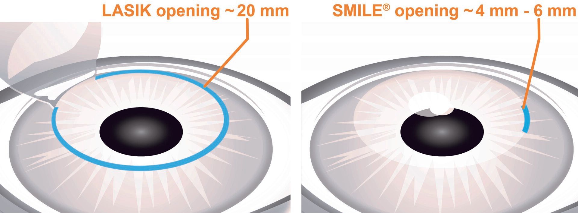 Ophthalmology Laser Microscope Operation | Roswell, NM | Engstrom Cataract and Laser Center
