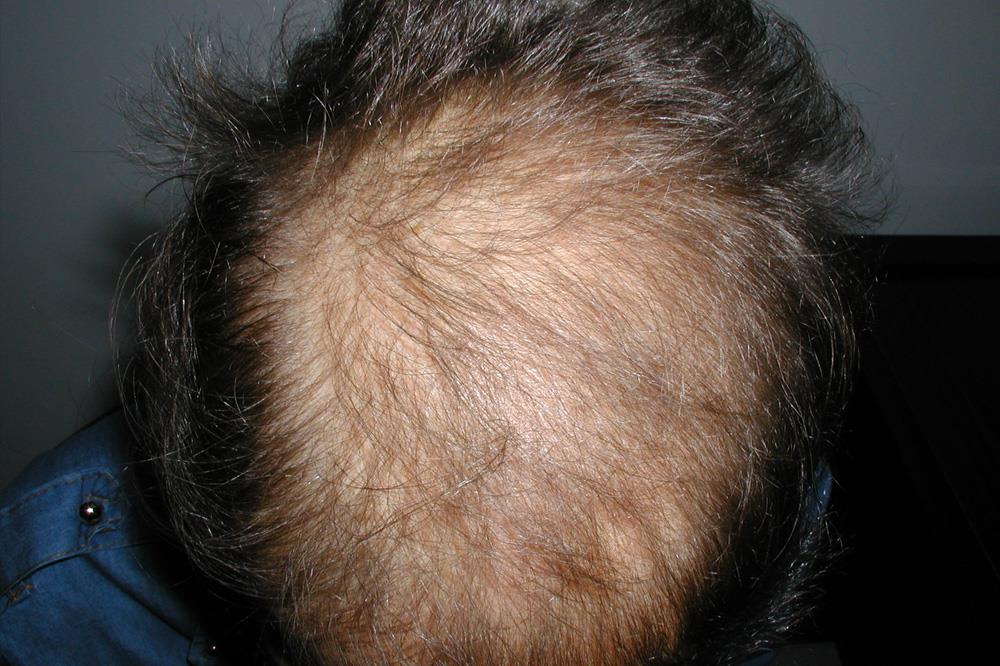 alopecia