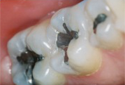Tooth