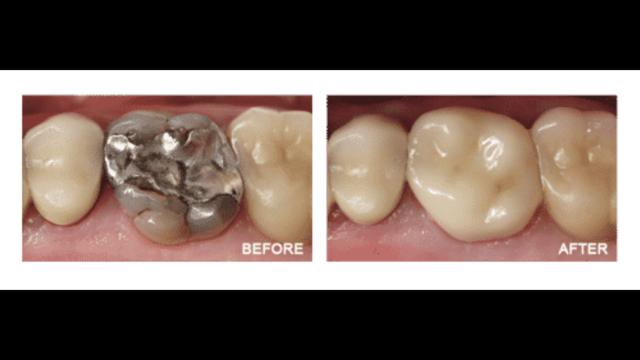 Cerec - Christiana Pleasant Dental