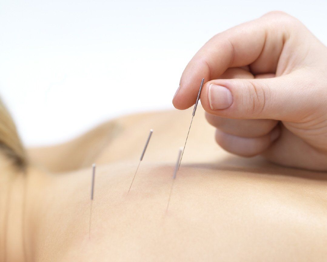 Acupuntura, punción seca,  ondas de choque, dolor, contractura, Zamora, experto, mejores,