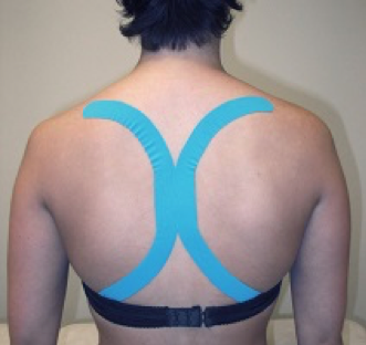 kinesiotape aangebracht in een X-vormig patroon over de bovenrug en schouders.