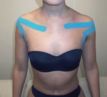 kinesiotape op schouders en borst.