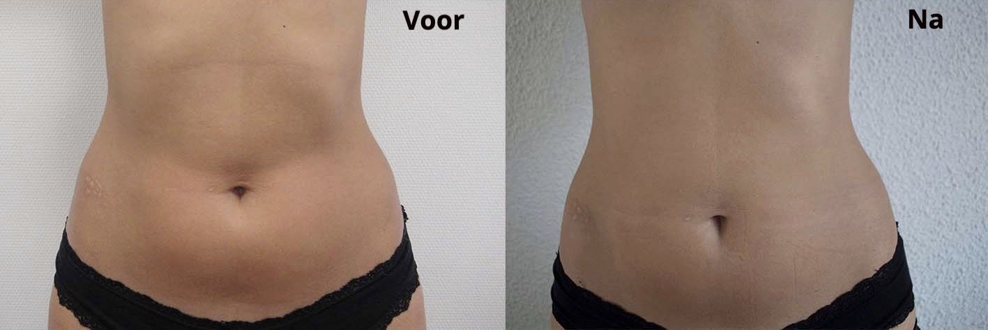 cryolipolyse amersfoort leusden