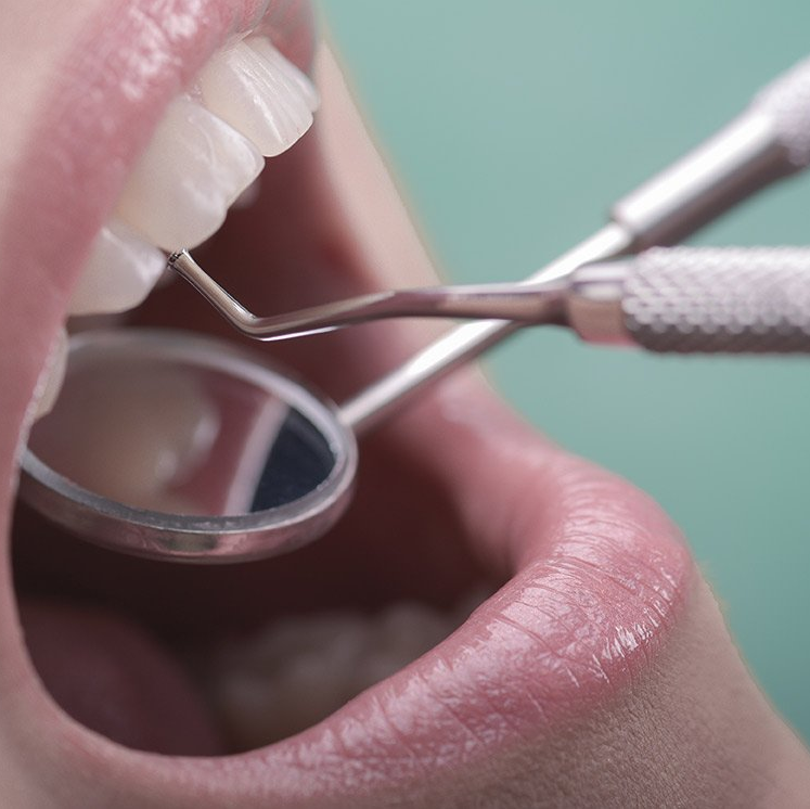 A patient receiving teeth whitening services in Surry Hills