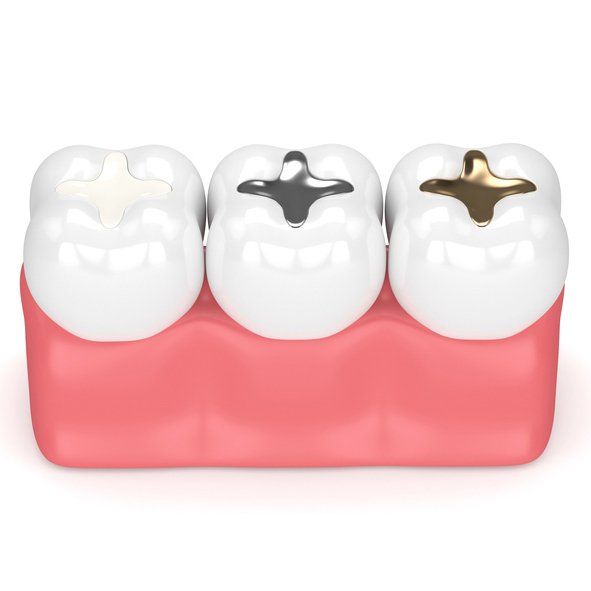 dental filling