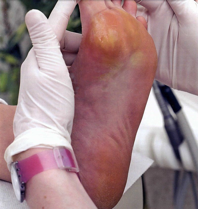 CORNS & CALLUSES treatment