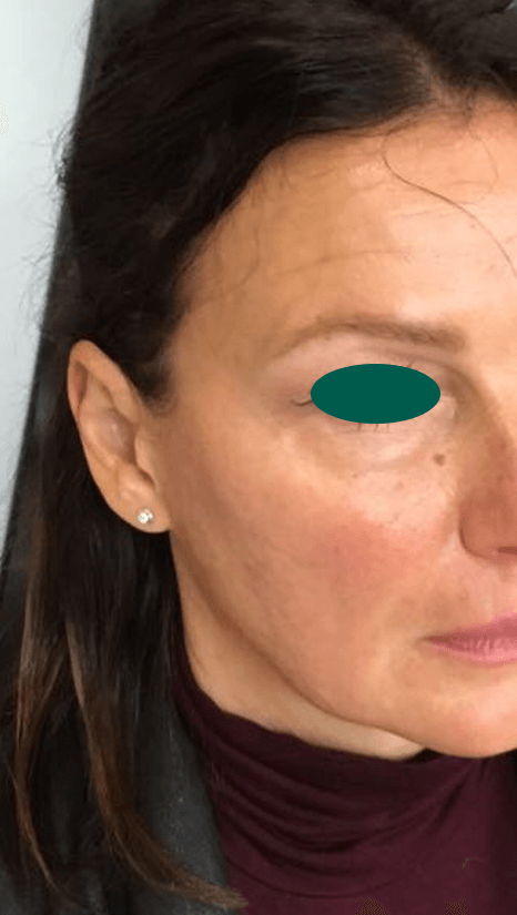 Cheek filler after