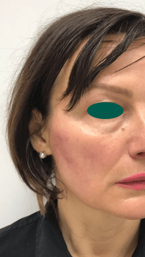 Cheek filler before