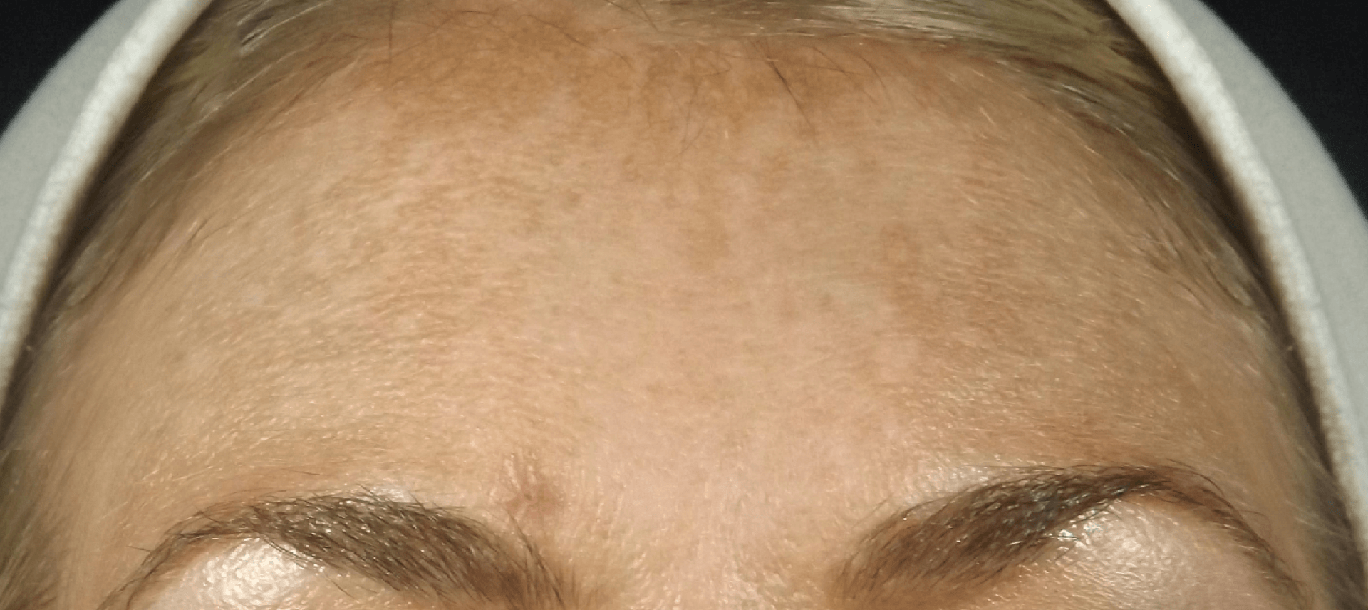 Jessner Peel for hyperpigmentation and melasma after