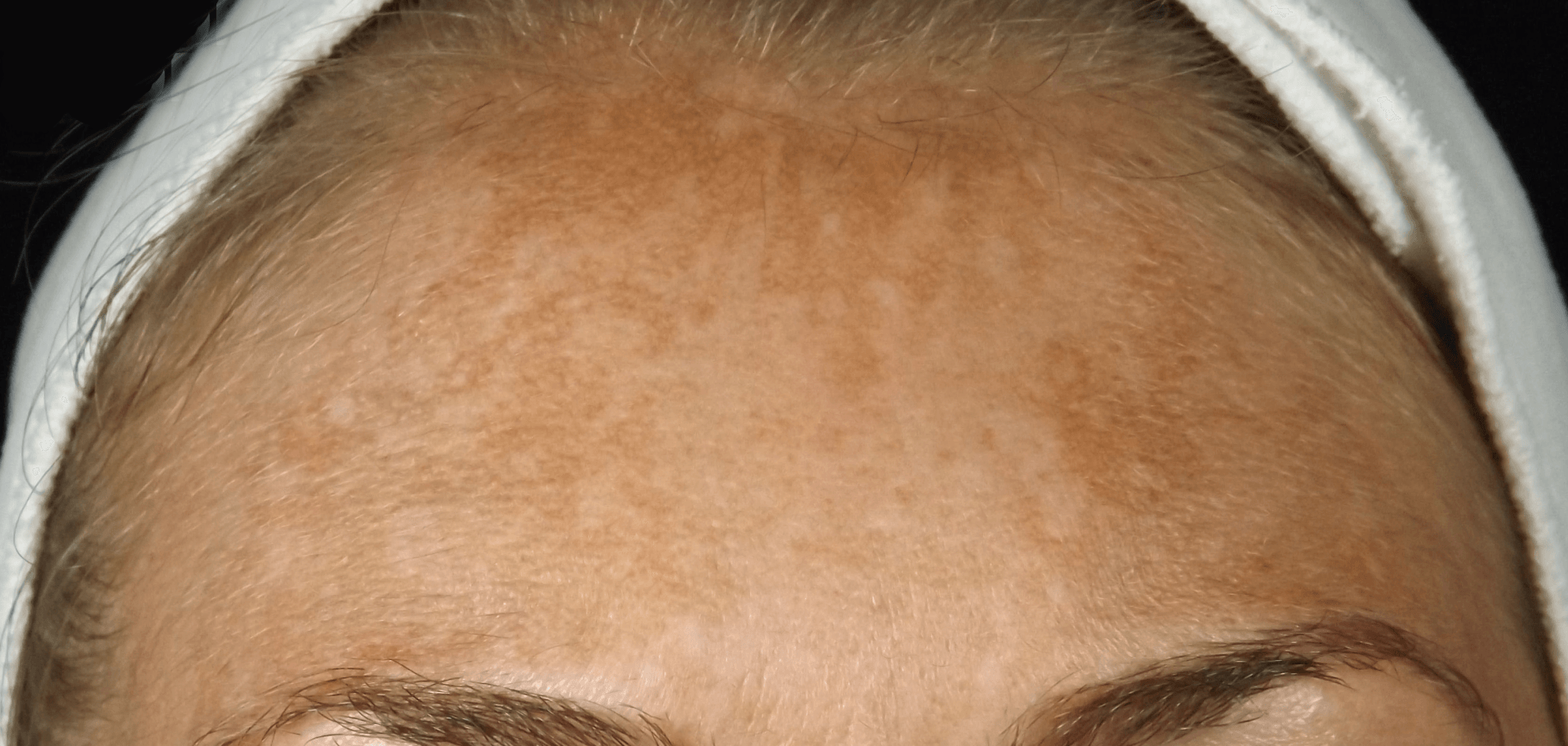 Jessner Peel for hyperpigmentation and melasma before