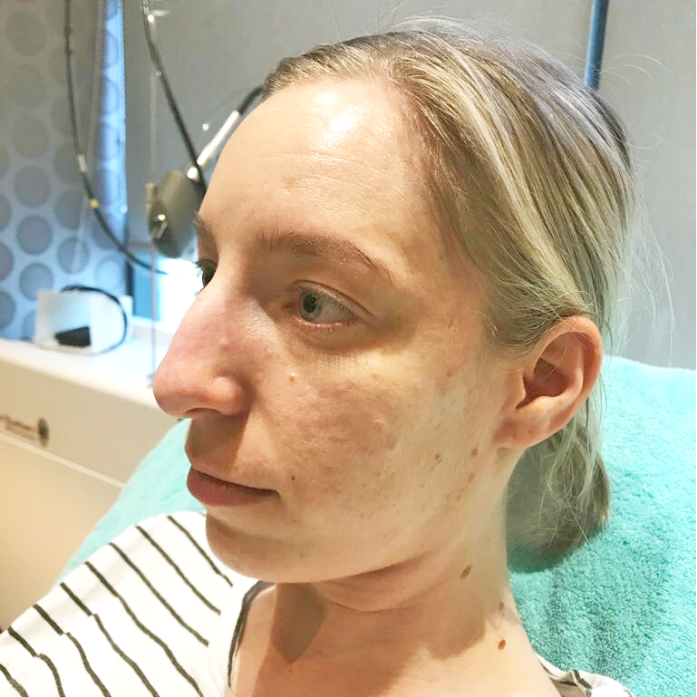Microneedling treatment before