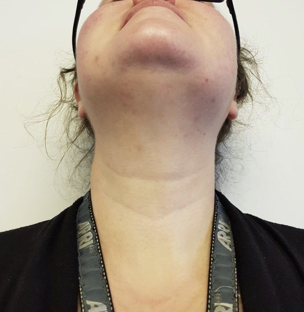 Skinade clear for acne after