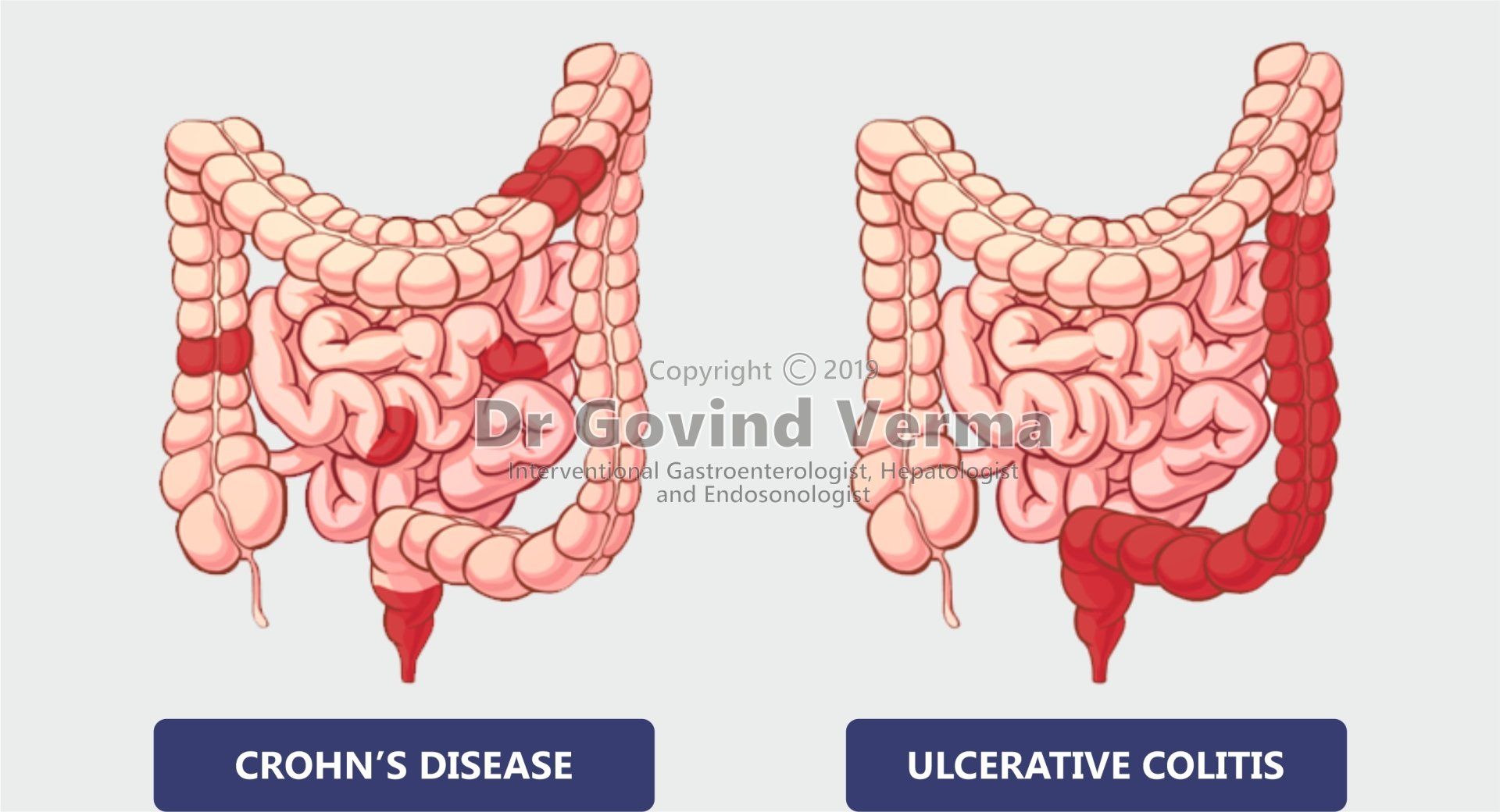 Inflammatory Bowel Disease - Crohn's disease, Ulcerative colitis