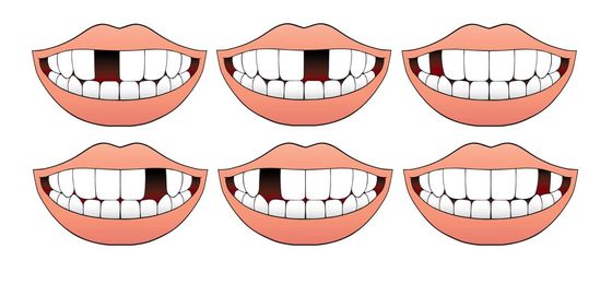 Illustrations of six smiling mouths showing different sets of teeth and lips