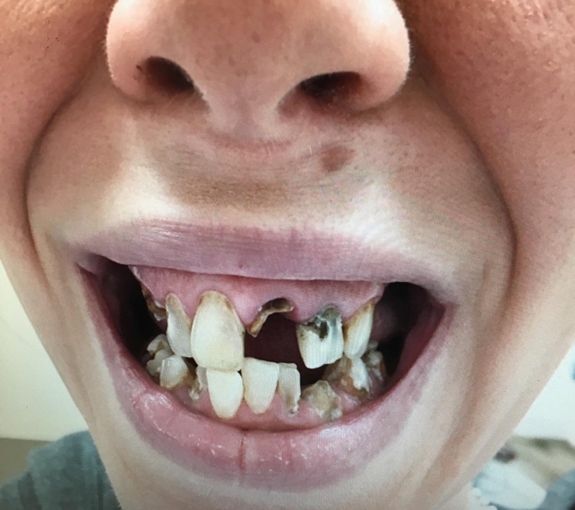 Close-up of a mouth with severely decayed, broken teeth and missing teeth