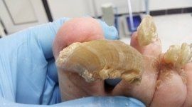 ortesi plantari ortesi piedi