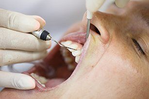 General Dentistry — Root Canal Treatment in Sacramento, CA