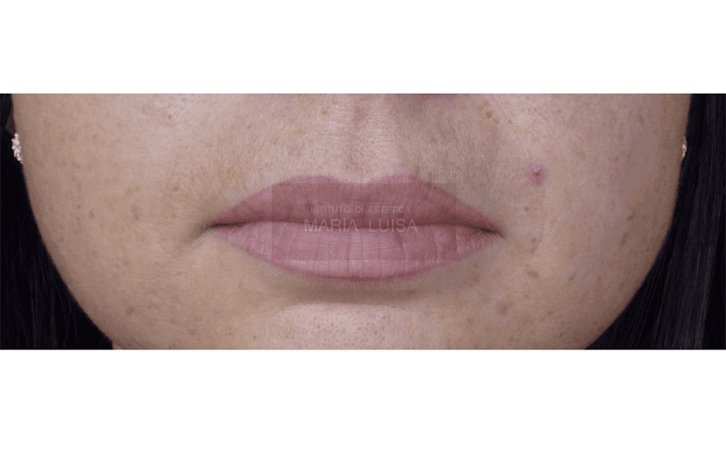 Labbra dopo ricostruzione con sfumatura effetto naturale