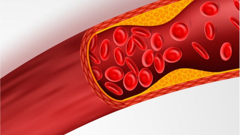 Atherosclerosis